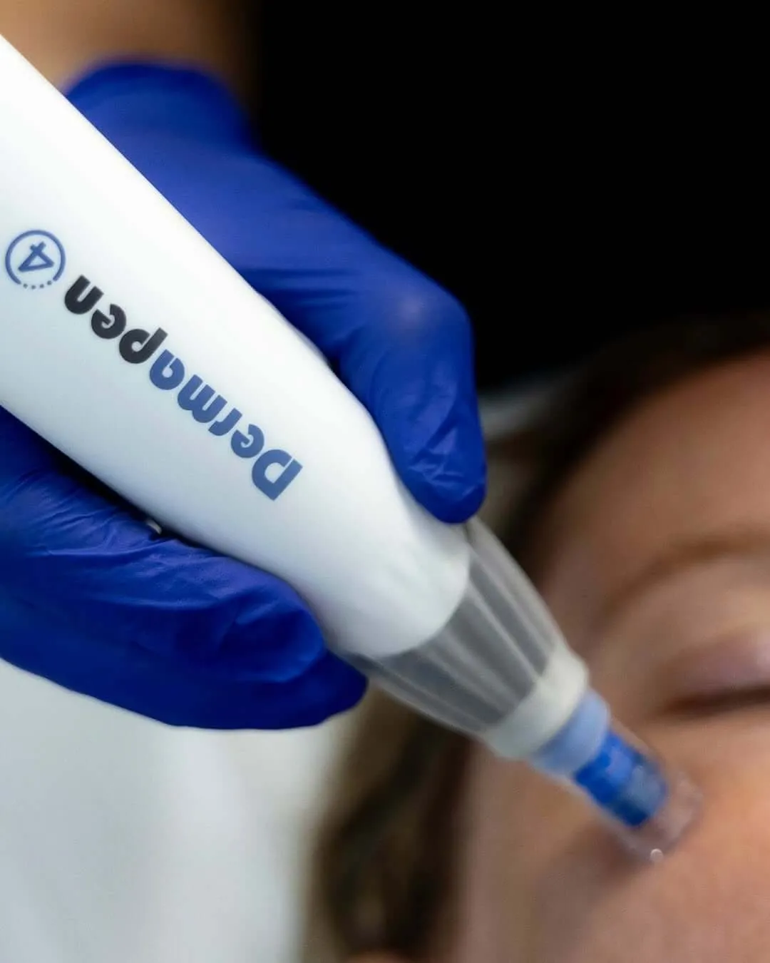 patient microneedling newport beach