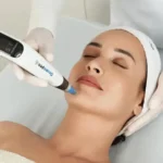 microneedling aftercare
