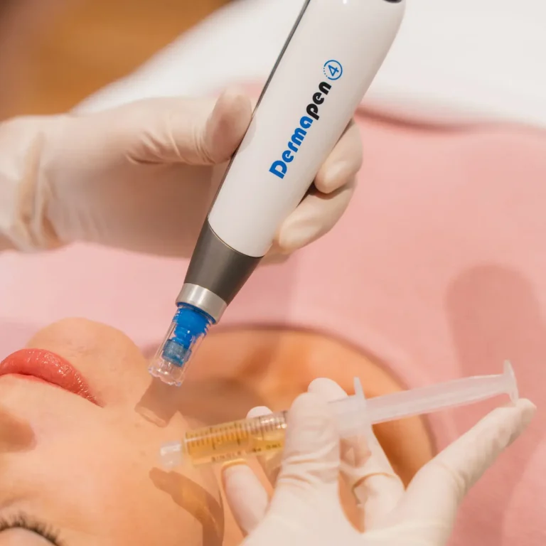 PRP Facial newport beach vampire facial newport beach