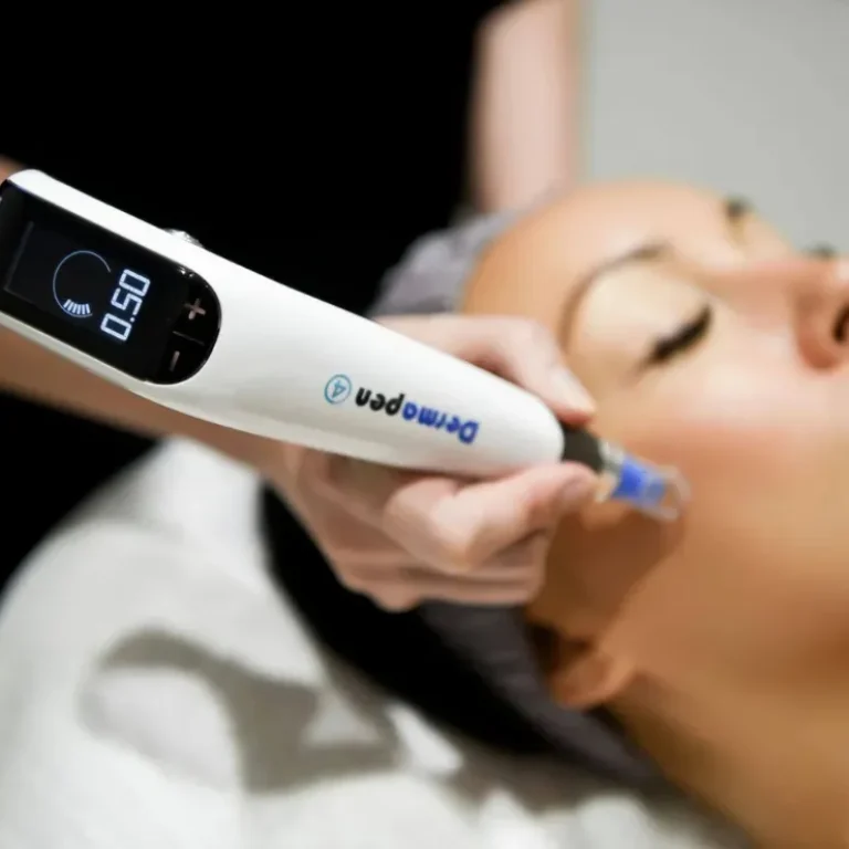 microneedling